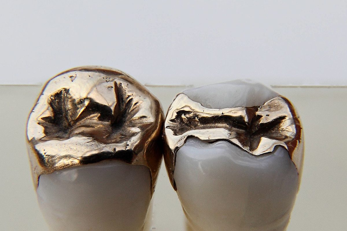 Cast gold restorations on two molars