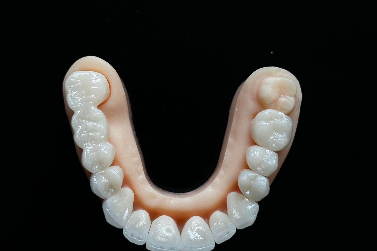 Finished crowns on a full-arch model