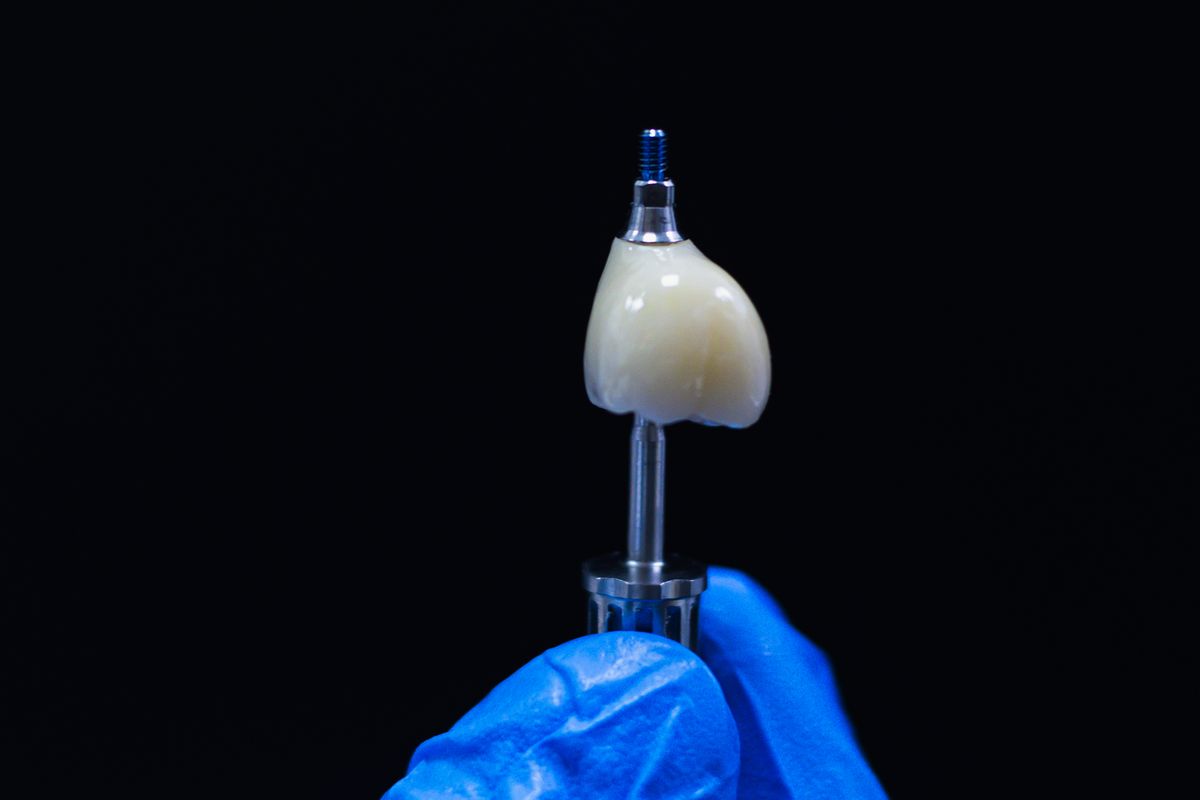 Implant crown on an abutment