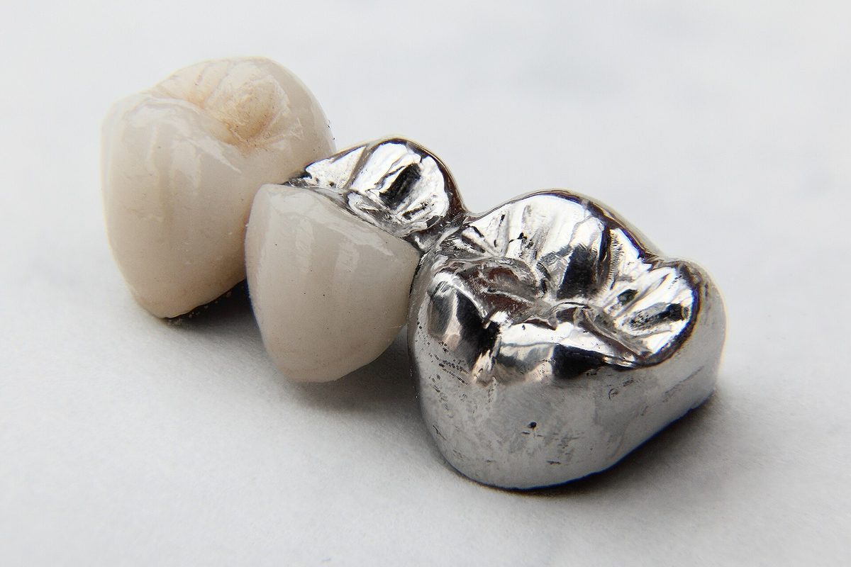 Porcelain-fused-to-metal bridge: porcelain units fused to a polished cast-metal framework